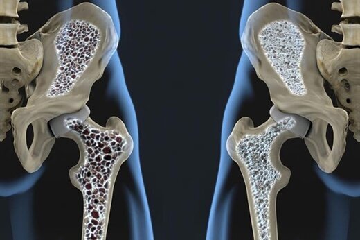 3  خطر بزرگ پوکی استخوان که کمتر کسی می‌داند